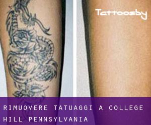 Rimuovere Tatuaggi a College Hill (Pennsylvania)