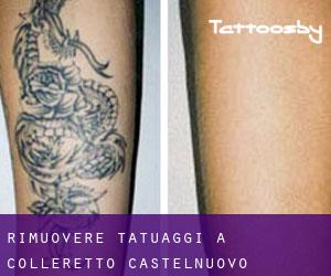 Rimuovere Tatuaggi a Colleretto Castelnuovo