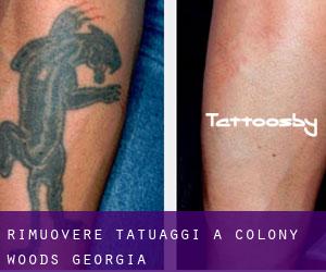 Rimuovere Tatuaggi a Colony Woods (Georgia)