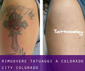 Rimuovere Tatuaggi a Colorado City (Colorado)