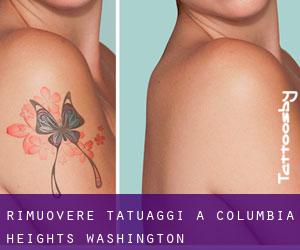 Rimuovere Tatuaggi a Columbia Heights (Washington)