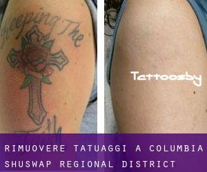 Rimuovere Tatuaggi a Columbia-Shuswap Regional District