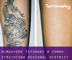 Rimuovere Tatuaggi a Comox-Strathcona Regional District
