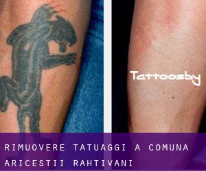 Rimuovere Tatuaggi a Comuna Ariceştii-Rahtivani