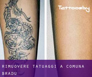 Rimuovere Tatuaggi a Comuna Bradu