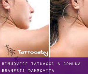 Rimuovere Tatuaggi a Comuna Brăneşti (Dâmboviţa)