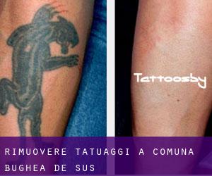 Rimuovere Tatuaggi a Comuna Bughea de Sus