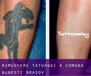 Rimuovere Tatuaggi a Comuna Buneşti (Braşov)