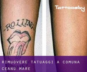 Rimuovere Tatuaggi a Comuna Ceanu Mare