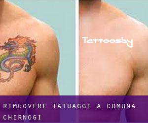 Rimuovere Tatuaggi a Comuna Chirnogi