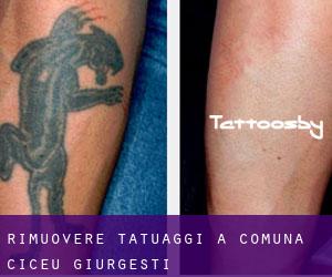 Rimuovere Tatuaggi a Comuna Ciceu-Giurgeşti