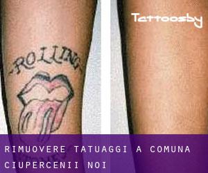 Rimuovere Tatuaggi a Comuna Ciupercenii Noi