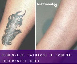 Rimuovere Tatuaggi a Comuna Cocorăştii-Colţ