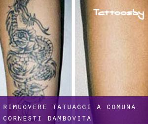 Rimuovere Tatuaggi a Comuna Corneşti (Dâmboviţa)