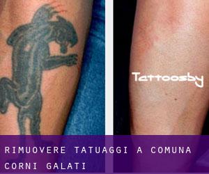 Rimuovere Tatuaggi a Comuna Corni (Galaţi)