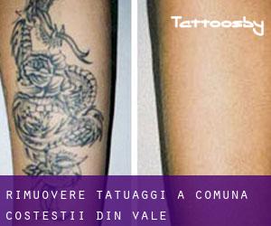 Rimuovere Tatuaggi a Comuna Costeştii din Vale