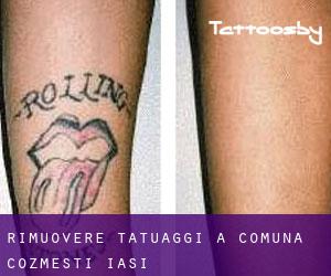 Rimuovere Tatuaggi a Comuna Cozmeşti (Iaşi)