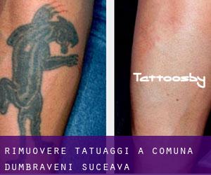 Rimuovere Tatuaggi a Comuna Dumbrăveni (Suceava)