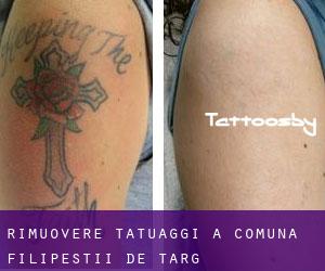 Rimuovere Tatuaggi a Comuna Filipeştii de Târg