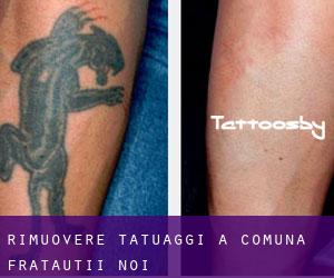Rimuovere Tatuaggi a Comuna Frătăuţii Noi