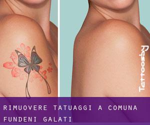 Rimuovere Tatuaggi a Comuna Fundeni (Galaţi)