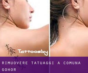Rimuovere Tatuaggi a Comuna Gohor