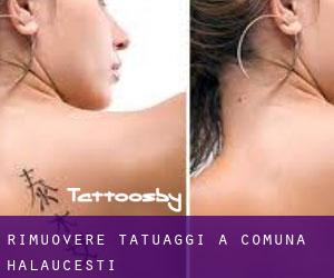Rimuovere Tatuaggi a Comuna Hălăuceşti