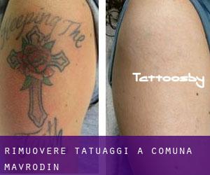 Rimuovere Tatuaggi a Comuna Mavrodin