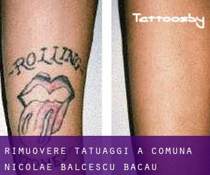 Rimuovere Tatuaggi a Comuna Nicolae Bălcescu (Bacău)