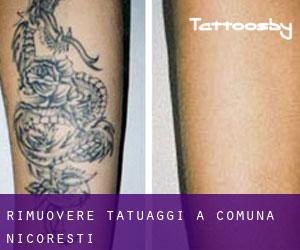 Rimuovere Tatuaggi a Comuna Nicoreşti