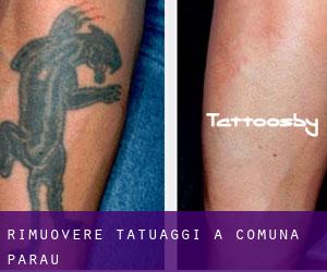 Rimuovere Tatuaggi a Comuna Pârâu