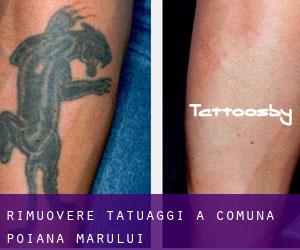 Rimuovere Tatuaggi a Comuna Poiana Mărului