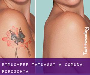 Rimuovere Tatuaggi a Comuna Poroschia