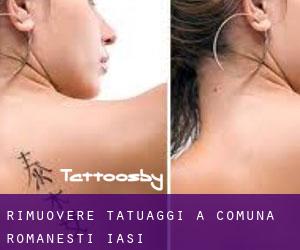Rimuovere Tatuaggi a Comuna Româneşti (Iaşi)