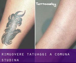 Rimuovere Tatuaggi a Comuna Studina