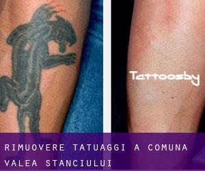 Rimuovere Tatuaggi a Comuna Valea Stanciului