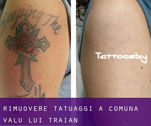 Rimuovere Tatuaggi a Comuna Valu lui Traian