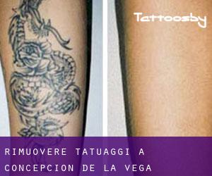 Rimuovere Tatuaggi a Concepción de la Vega