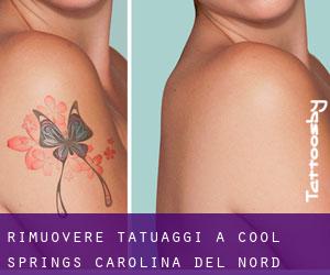 Rimuovere Tatuaggi a Cool Springs (Carolina del Nord)