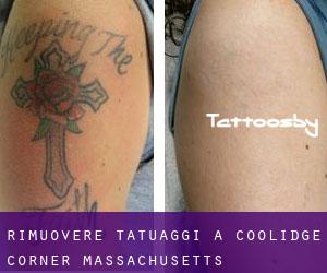 Rimuovere Tatuaggi a Coolidge Corner (Massachusetts)