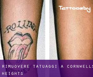 Rimuovere Tatuaggi a Cornwells Heights