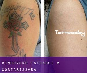 Rimuovere Tatuaggi a Costabissara