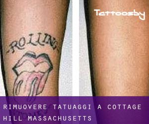 Rimuovere Tatuaggi a Cottage Hill (Massachusetts)