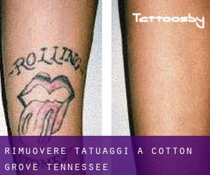 Rimuovere Tatuaggi a Cotton Grove (Tennessee)
