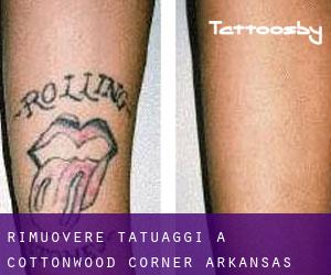 Rimuovere Tatuaggi a Cottonwood Corner (Arkansas)