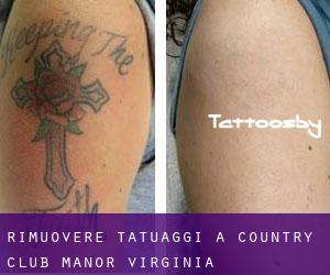 Rimuovere Tatuaggi a Country Club Manor (Virginia)