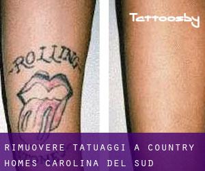 Rimuovere Tatuaggi a Country Homes (Carolina del Sud)