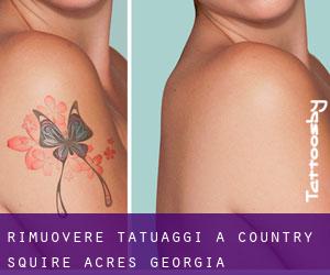 Rimuovere Tatuaggi a Country Squire Acres (Georgia)