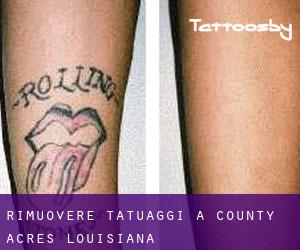 Rimuovere Tatuaggi a County Acres (Louisiana)