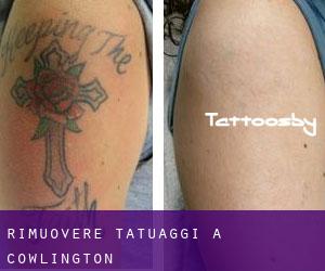 Rimuovere Tatuaggi a Cowlington